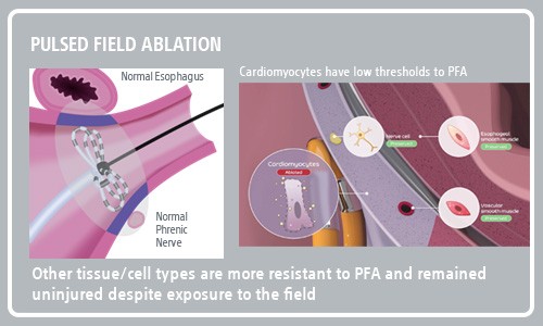 PFA Science and Tissue Labeled Illustration