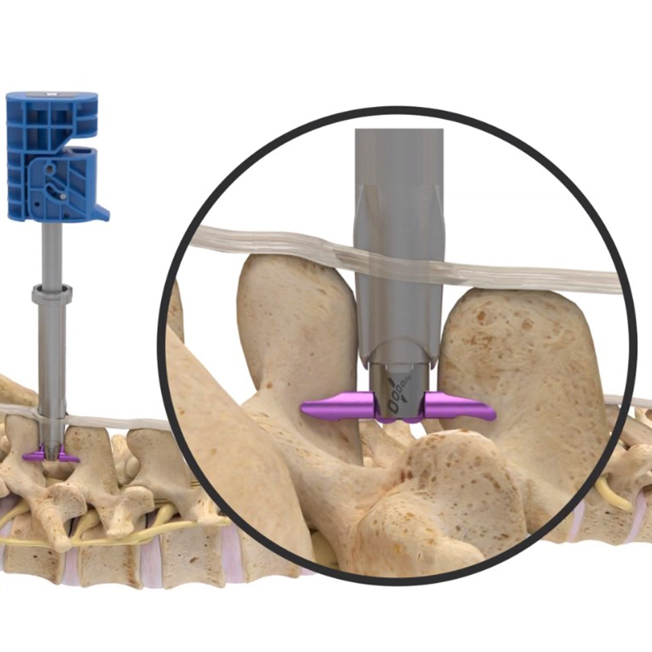 The Vertiflex™ Procedure† with Superion™ Indirect Decompression System Video
